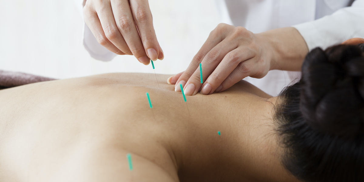 Acupuncture treatment Oakridge Physiotherapy Vancouver